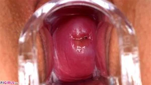 Cervix  thumbnail