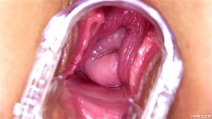 Speculum thumbnail