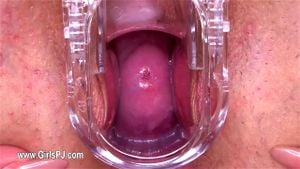 Speculum thumbnail