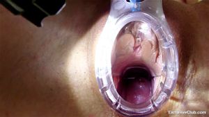 CERVIX thumbnail