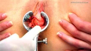 Gyno thumbnail