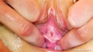 Gyno thumbnail