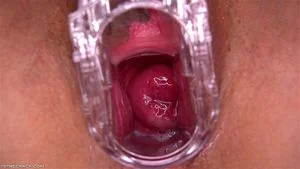 Smiling Cervix