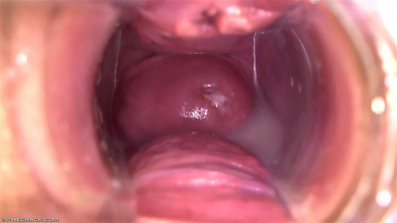 Puddle around her Cervix Puddle around her Cervix