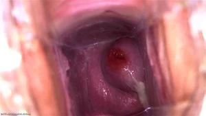 Cervix Snot
