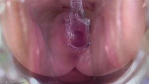 Speculum thumbnail