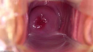 Cervix thumbnail