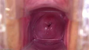 Cervix thumbnail