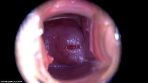 Speculum thumbnail