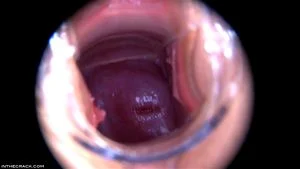 Speculum thumbnail