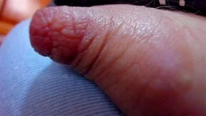 Hairy thumbnail