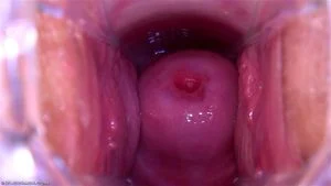 CERVIX thumbnail