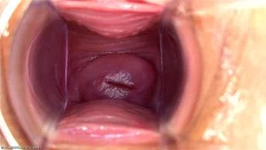 Cervix extreme thumbnail