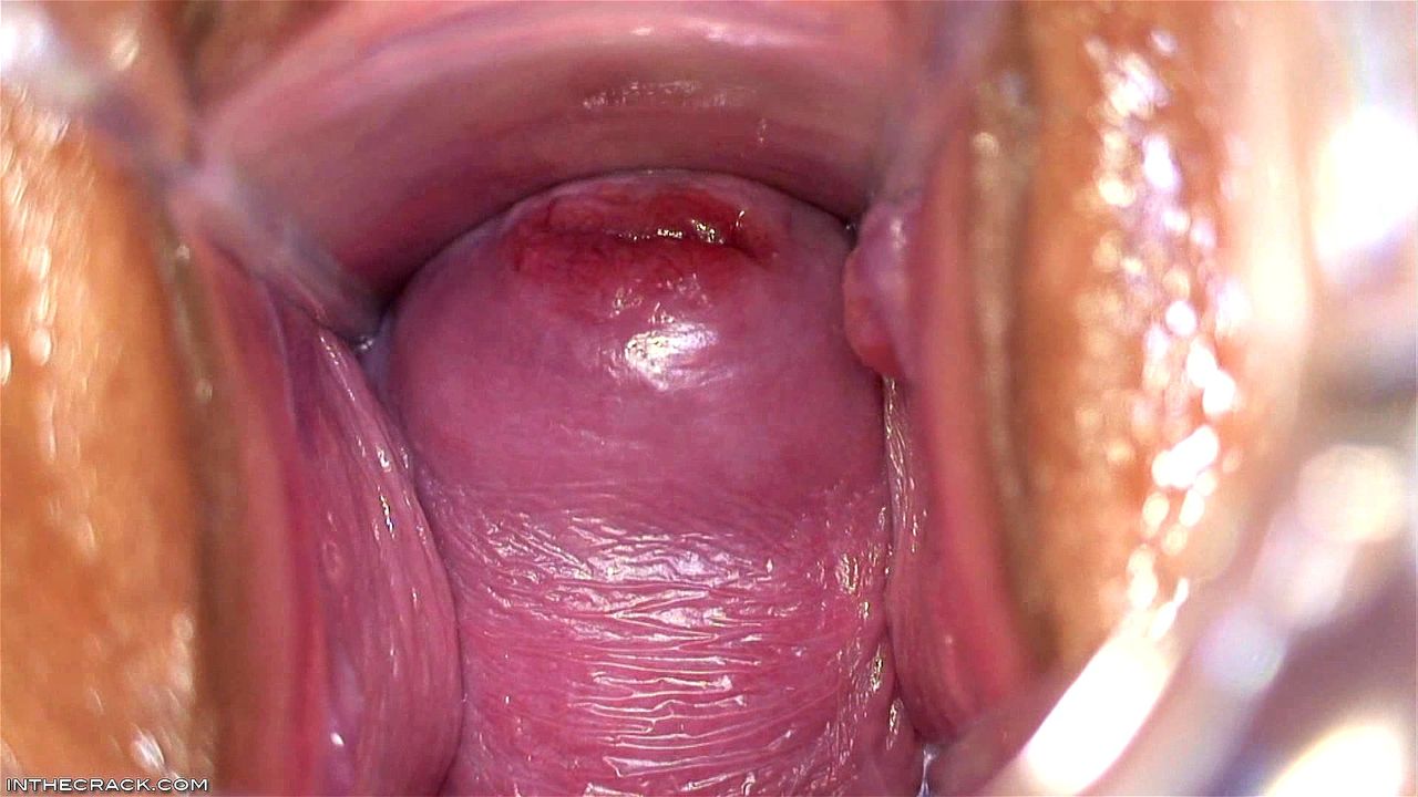 inthecrack cervix 