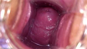 Cervix thumbnail