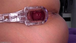 Cervix thumbnail