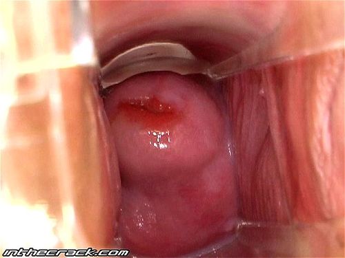 Cervix porn video – Eufrat's Orifice