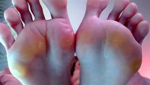 Callused soles thumbnail