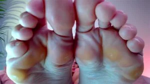 Calloused feet thumbnail