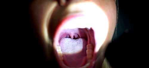 Long tongue uvula thumbnail