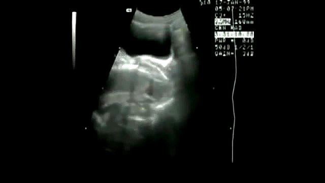 Ultra sound