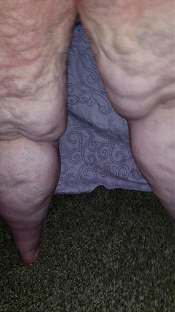 Cellulite