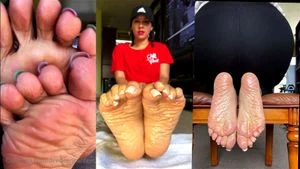 foot complication thumbnail