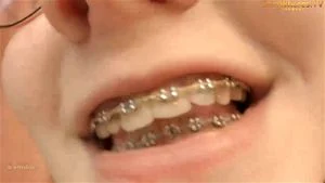 braces thumbnail