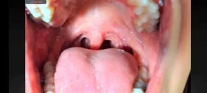 Tongue thumbnail