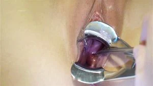 Cervix insertion thumbnail