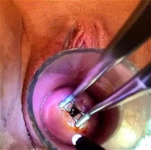 cervix thumbnail