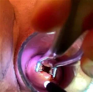 cervix thumbnail