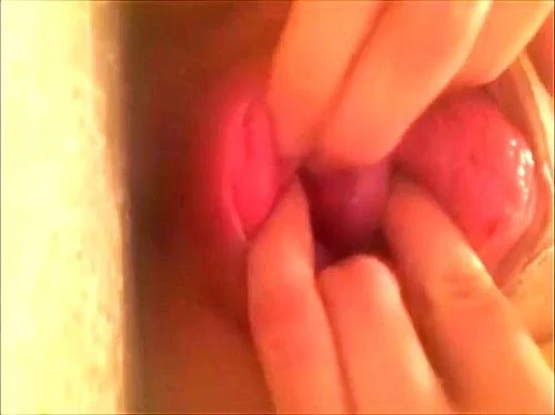 Cervix out thumbnail