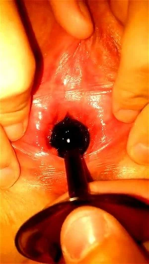 Anal bead peehole