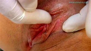 Gyno thumbnail