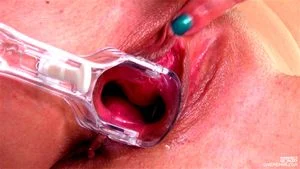 Speculum thumbnail