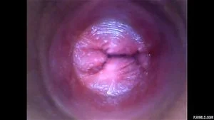 CERVIX thumbnail