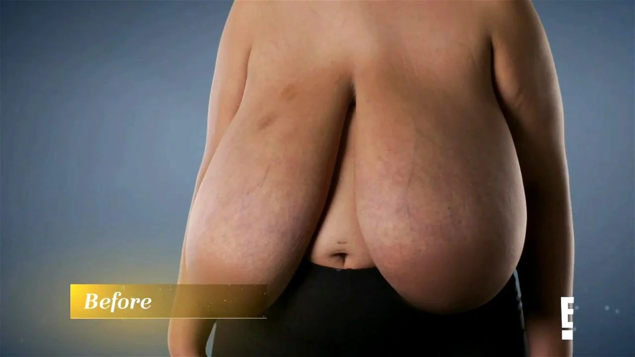 Watch Carlena reduction (warning: gore surgery) - Macromastia, Ugly, Big Boobs  Porn - SpankBang