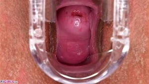 speculum thumbnail