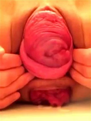 Cervix out thumbnail