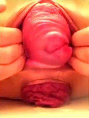 Cervix out thumbnail